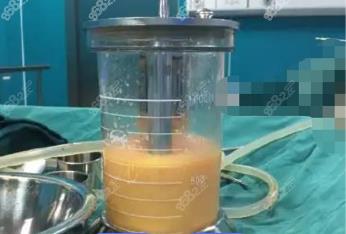 永兴360度水动力吸脂费用多少钱？
