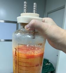 永兴水动力吸脂手术要做多久？